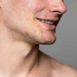 Apa itu Purging Wajah? Bagaimana Ciri-cirinya? Temukan Jawabannya di sini!