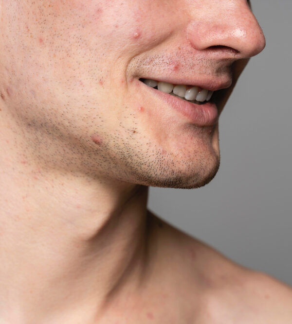 Apa itu Purging Wajah? Bagaimana Ciri-cirinya? Temukan Jawabannya di sini!